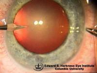 Paracentesis